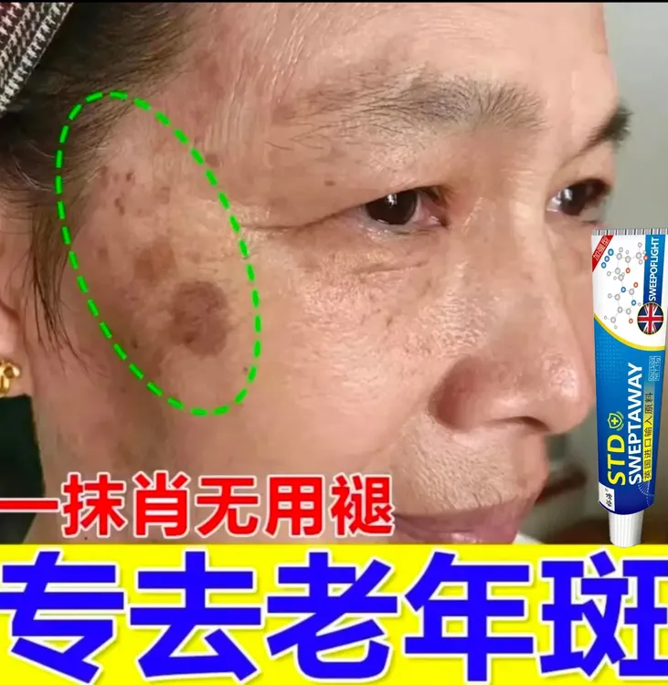 祛脸上老年斑专用膏强力去手部脸部去黑斑淡黄褐斑雀斑老人霜