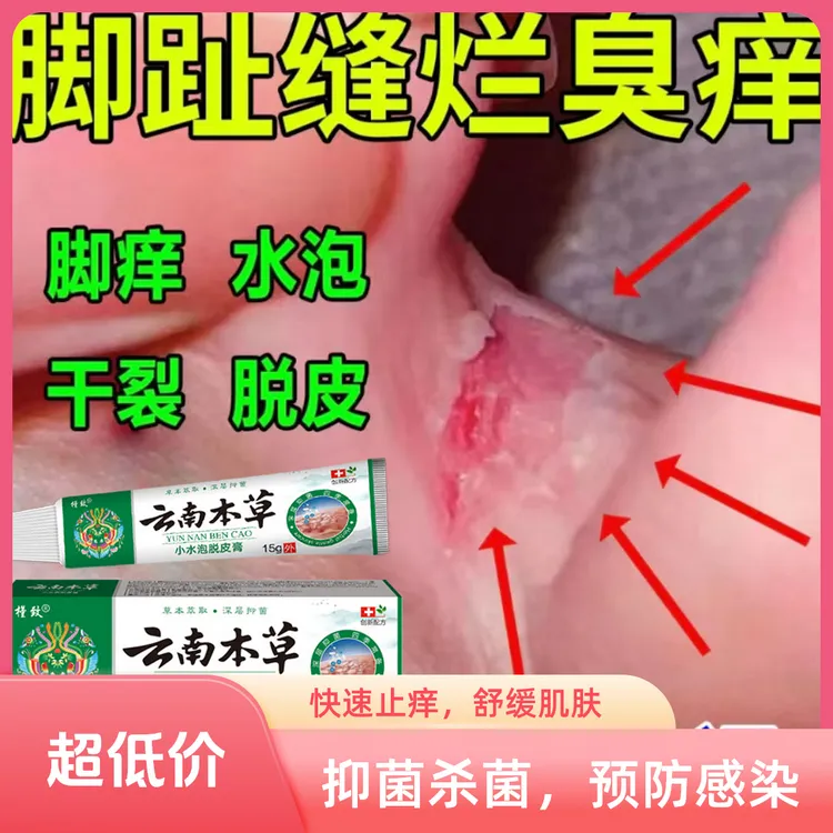 云南本草脚臭止痒烂脚神器正品脚丫溃烂真菌感染起小水泡又痒抑菌