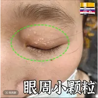 眼部脂肪颗粒神器男女通用眼睛周小颗粒油脂粒汗管黄色小疙瘩