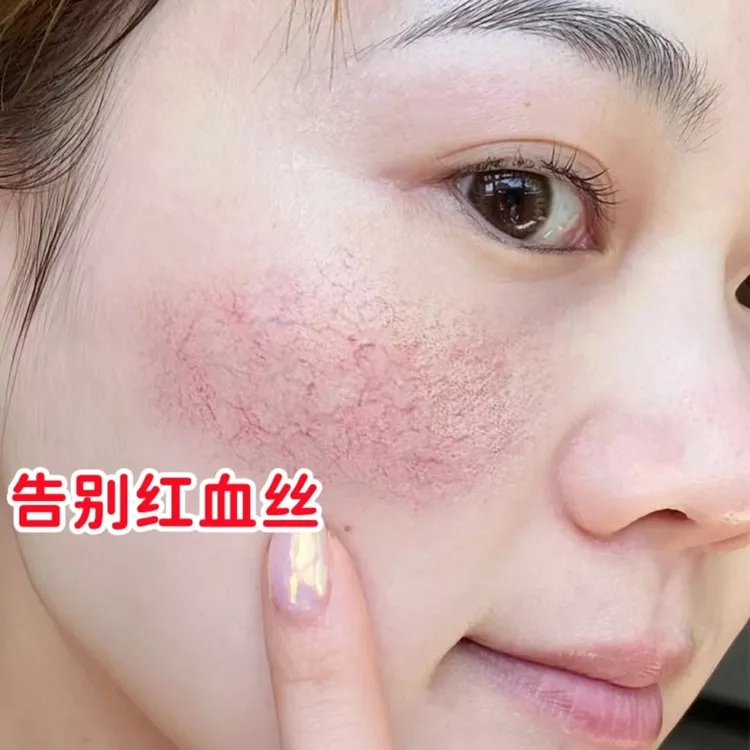 红血丝角质层薄改善大红脸面部泛红舒缓高原红保湿强韧屏障精华液
