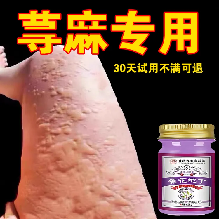 【荨麻珍专用】全身干痒湿痒急慢性胆碱性划痕风团皮肤止痒草本乳膏