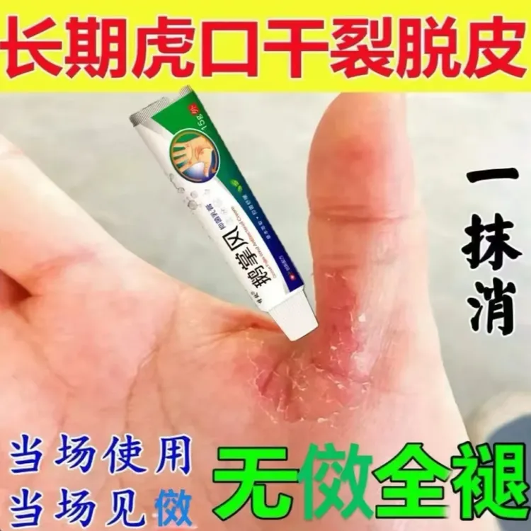 鹅掌风手部干裂脱皮手痒手裂口子手足起泡开口开裂起皮草本抑菌膏