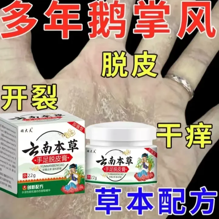 【买1送1正品】云南本草手足脱皮膏鹅掌风干裂脱皮手痒手裂
