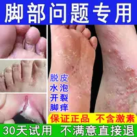 脚痒专用抑菌止痒膏脚臭气干裂脱皮起水泡汗脚趾缝痒喷剂克星神器