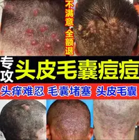 头皮毛囊头起长小红圪塔脓包头屑痘痘头部特效专用止痒乳膏