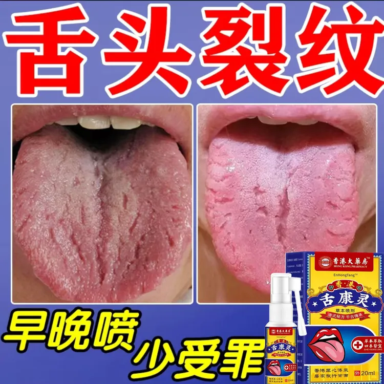 舌头有裂痕裂纹舌烂舌头起泡白苔麻木舌头痛喷剂地图舌抑菌