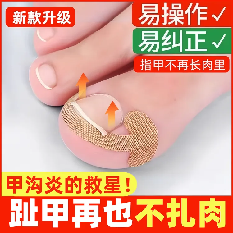 甲沟神器指甲矫正器隔离脚趾甲长肉里填充垫片纠正炎嵌甲专用拉贴