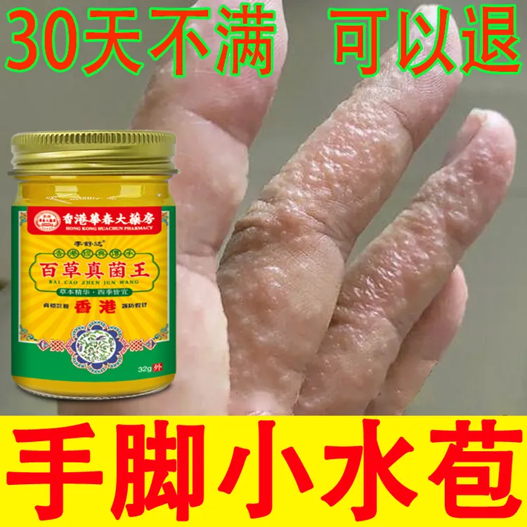 汗泡诊手指缝长小水泡痒手指开裂手指脱皮专用手足抑菌舒适止痒膏