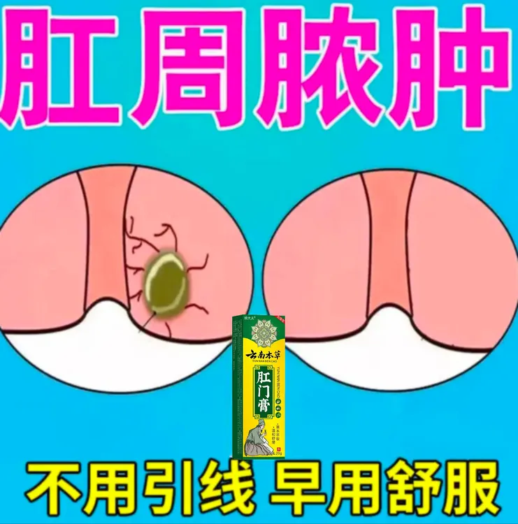 肛周有脓肿特效乳膏肛周经常疼痛肛瘘硬块草本温和外用涂抹乳膏