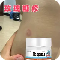 玫瑰糠疹铜钱藓体藓猫藓离型性环状红斑皮肤干燥瘙痒全身藓痒膏