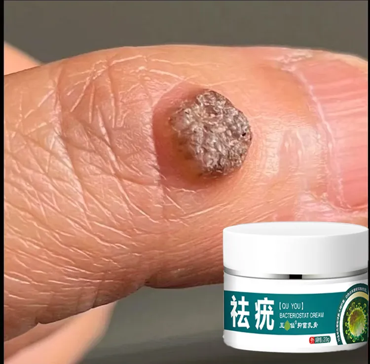 【香港大薬房】瘊优膏克尤抑菌乳膏丝状瘊子小肉粒专用正品身体护理