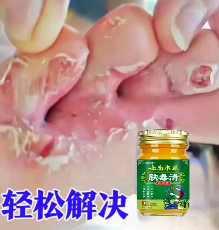 止痒膏去脚出汗脱皮起水炮干裂脚趾缝痒抑菌止痒神器足部护理