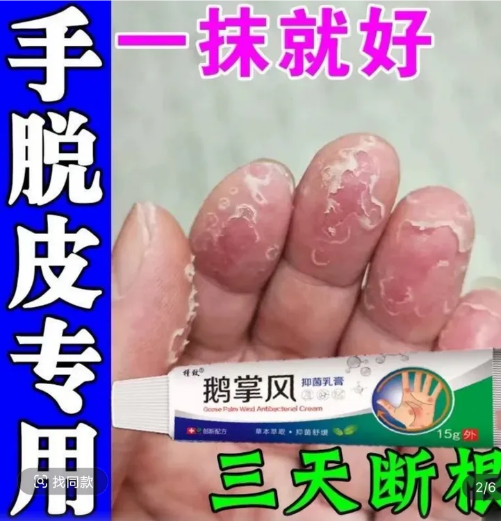 手足脱皮膏鹅掌风干裂脱皮手痒手裂口手足霜手足软膏脚干软膏