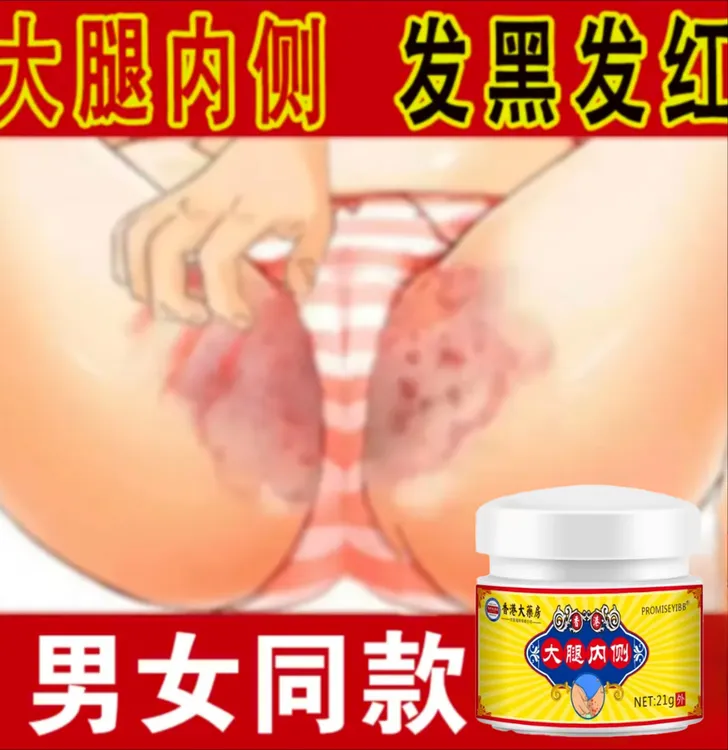 男女通用大腿内侧好痒越抓越痒潮~湿红~肿~异味痒外用止痒软膏