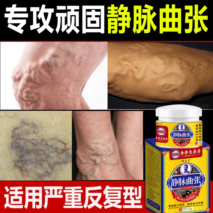 静-脉-曲张香港蚯蚓-腿专用黑红-血-丝止痒身体护理