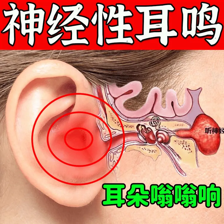 神经性耳鸣脑鸣蝉鸣听力下降耳朵嗡嗡响专用膏影响睡眠神经衰弱