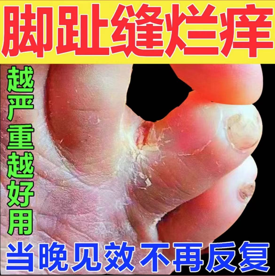 脚趾缝烂痒烂脚丫脱皮烂脚趾缝烂痒神器止痒脱皮修护软膏