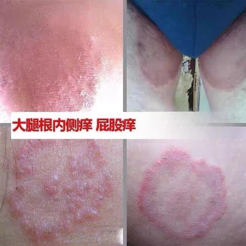 股膏体股大腿内侧痒股真菌感染屁股股湿抑菌止痒膏