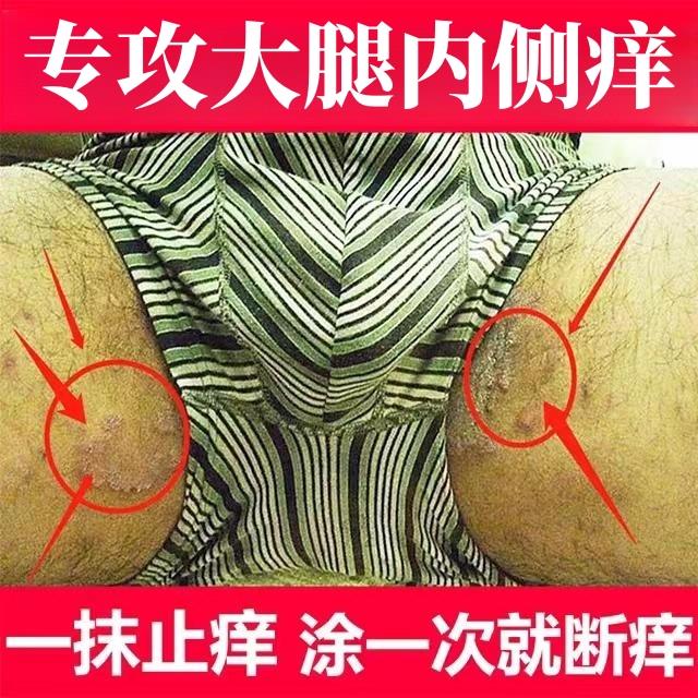 湿毒清软膏外用全身痒皮肤抑菌大腿内侧痒男士外用抑菌止痒膏