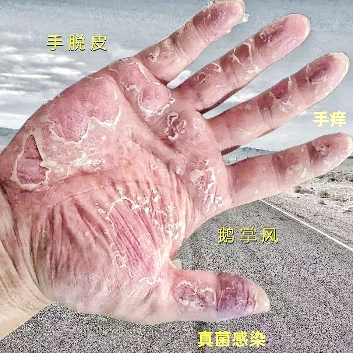 手掌脱皮起泡干裂手痒修护膏手部脱皮痒抑菌止痒湿鲜膏外用