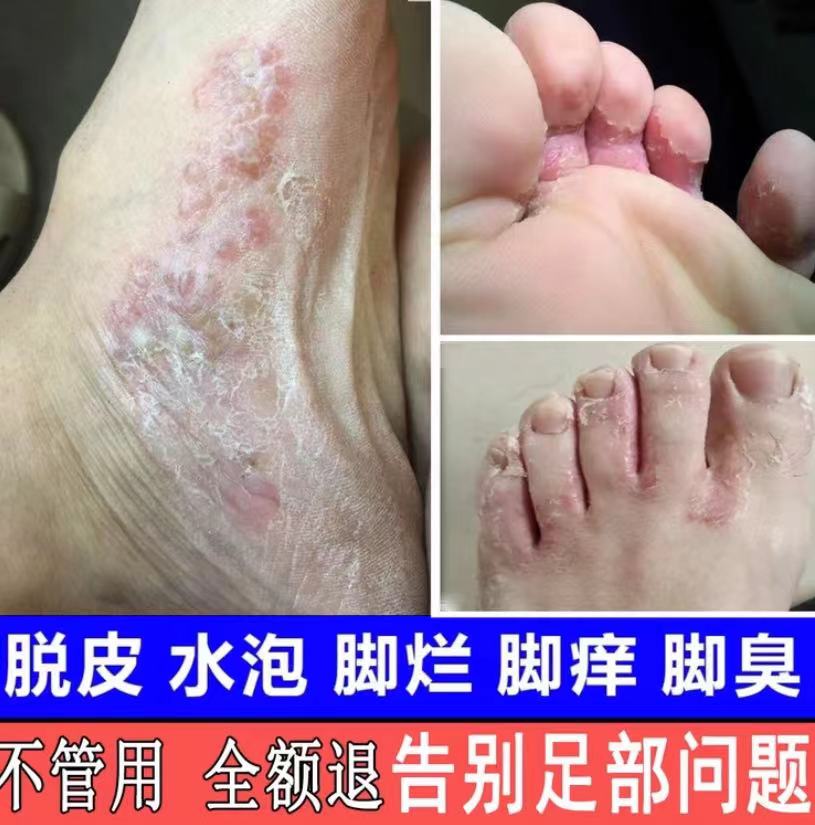 脚痒脚臭止痒膏去脚出汗脱皮起水泡干裂脚趾缝痒喷剂抑菌止痒神器