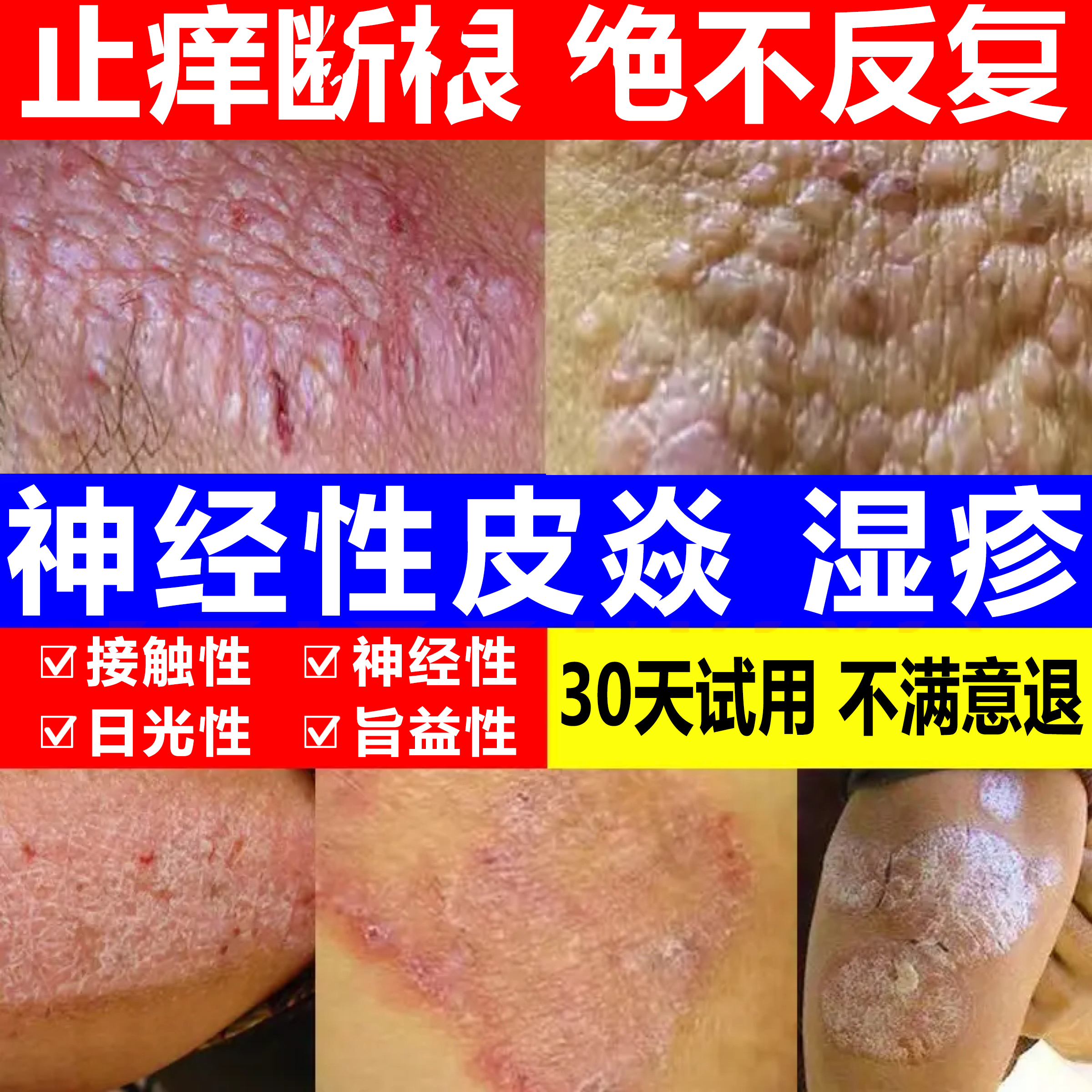 神经性皮肤止痒膏顽固皮手足抑菌乳膏特效修复湿痒克星止痒膏正品