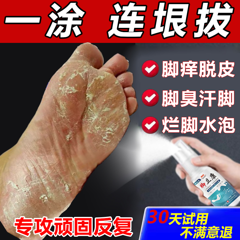 去脚止痒脚臭气脱皮脚底干裂水泡烂脚喷雾膏烂脚趾缝止痒神器正品