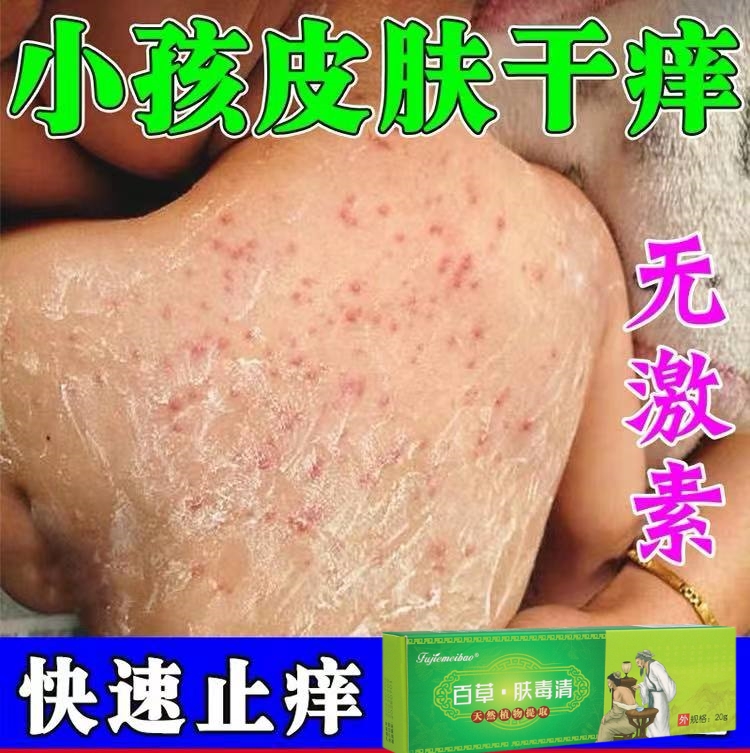 秋冬天儿童皮肤干燥痒止痒膏冬季小孩皮肤干痒身上起红疙瘩痒软膏