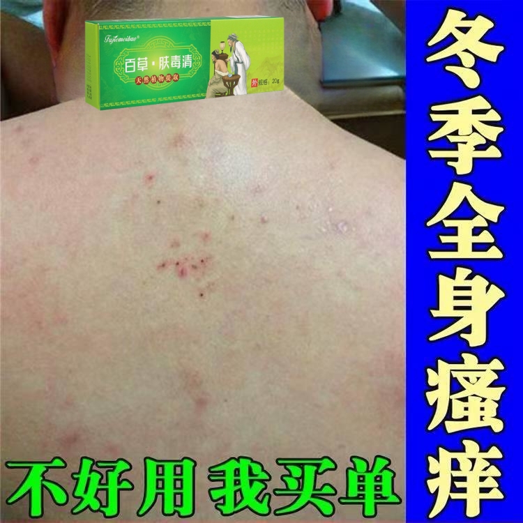 涂抹皮肤干燥痒止痒冬季晚上身上后背起红疙瘩红点痒的抓出血软膏