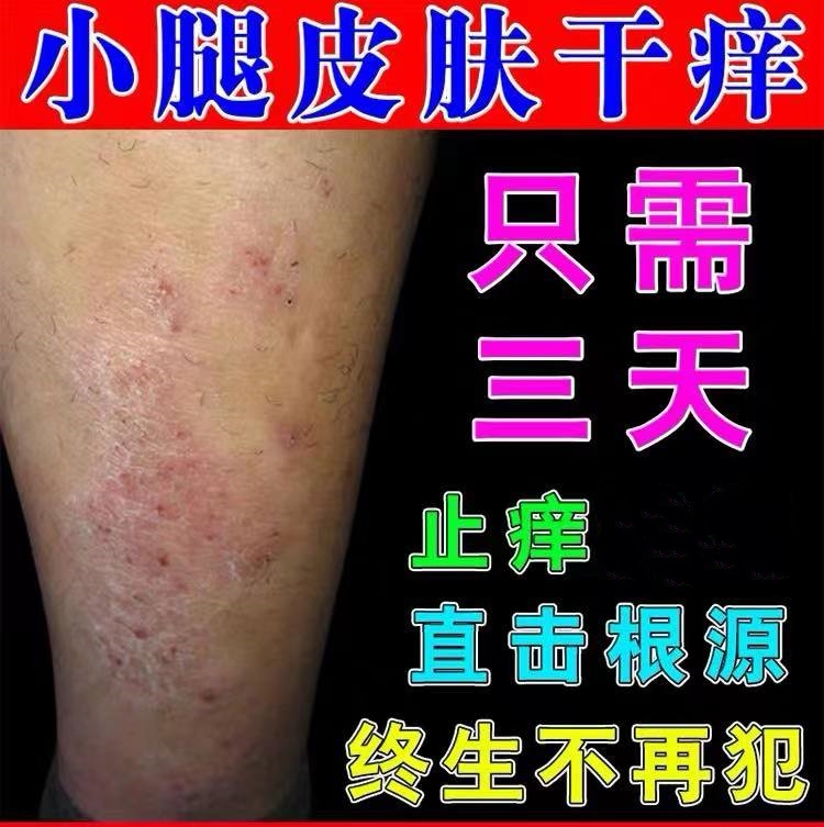 秋冬腿痒换季小腿全身皮肤红痒起红疙瘩皮肤干燥痒抑菌止痒软膏
