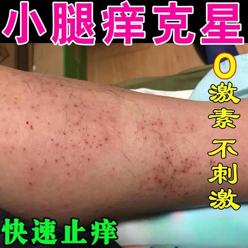 腿上干燥起皮小腿皮肤痒秋冬腿部长红点痒越抓越痒止痒抑菌软膏