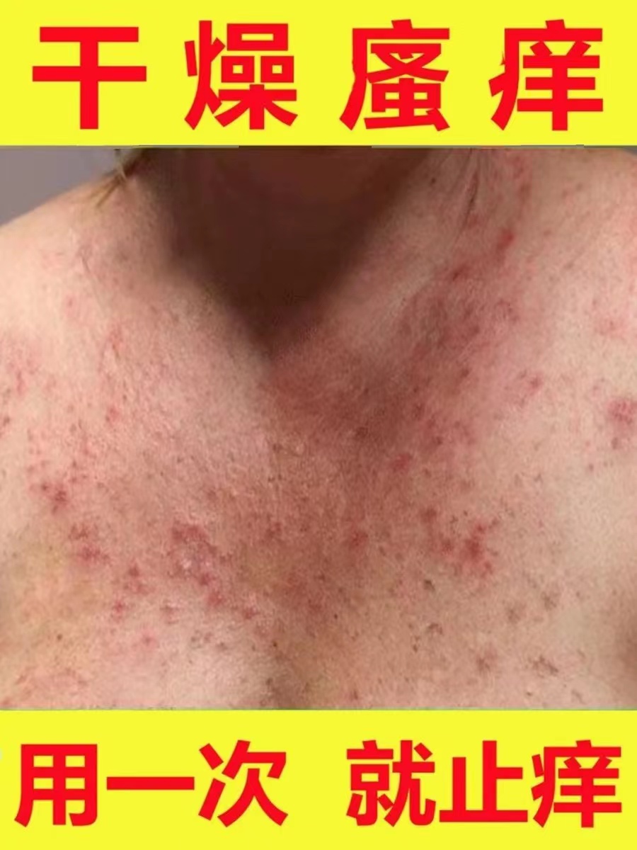 全身身上痒冬季皮肤痒干燥起红疙瘩红点痒成人儿童外用止痒抑菌膏