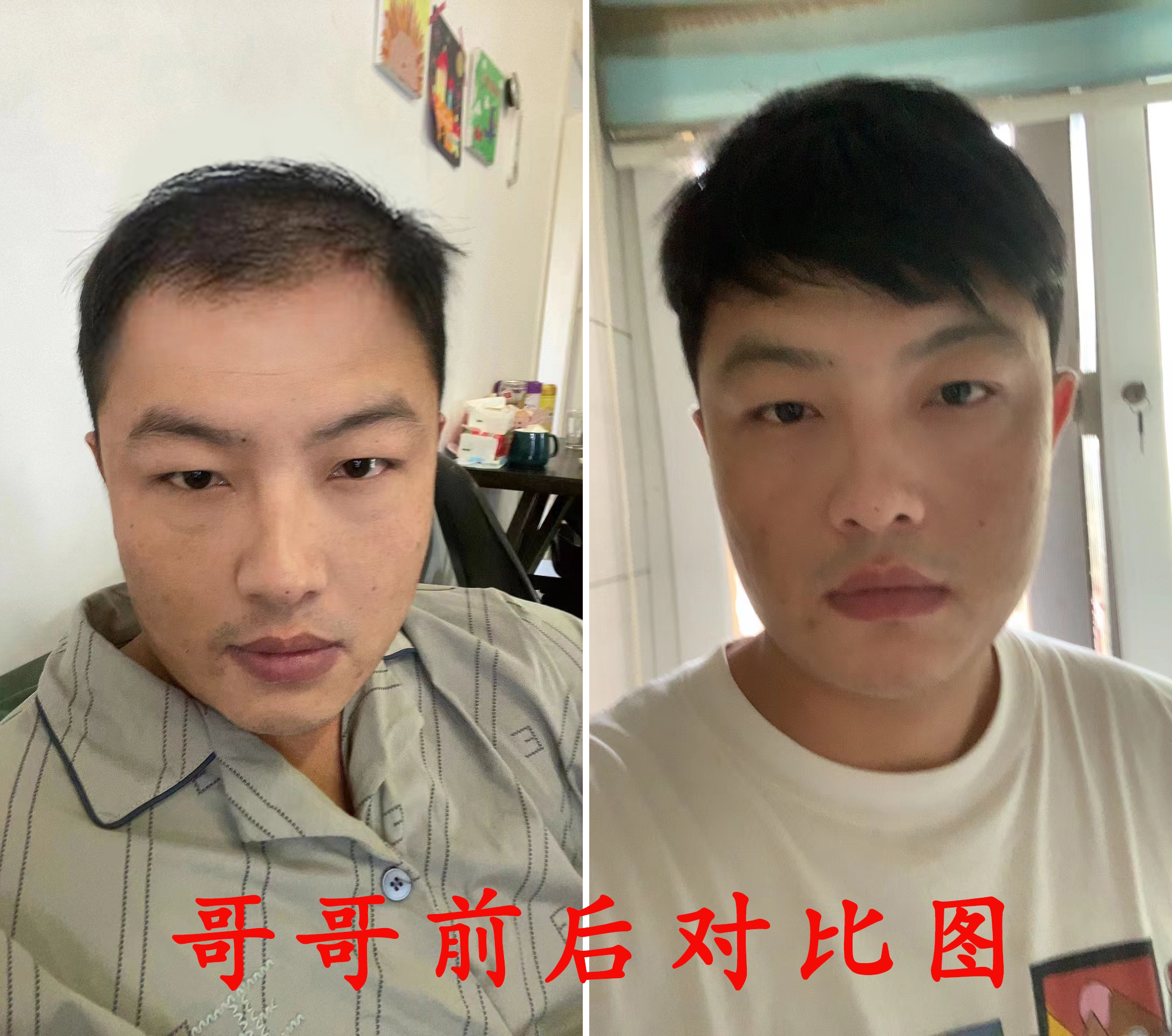 苗苗哥哥养发前后对比气垫梳子