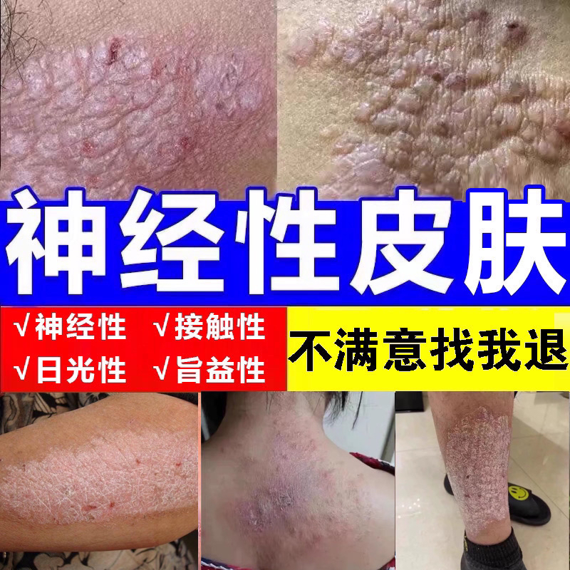 神经性皮肤止痒膏顽固皮手足脖子小腿湿痒抑菌乳膏特效修复克星