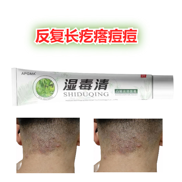 上长疙瘩外用涂抹软膏草本温和