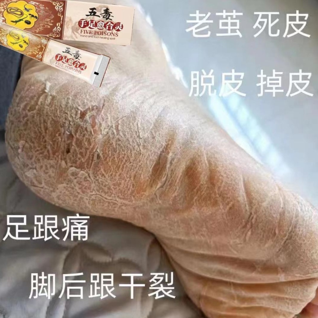 脚脱皮发白脚臭蜂窝状小孔窝粗糙烂脚趾缝脱皮软膏防干