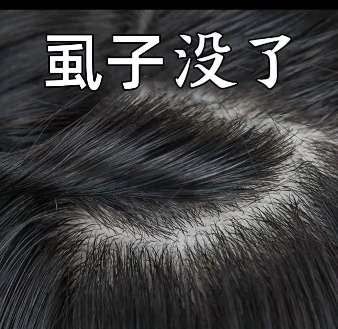 儿童祛虱子百部酊喷雾祛除虱子卵小女孩头发除虱子克星喷剂
