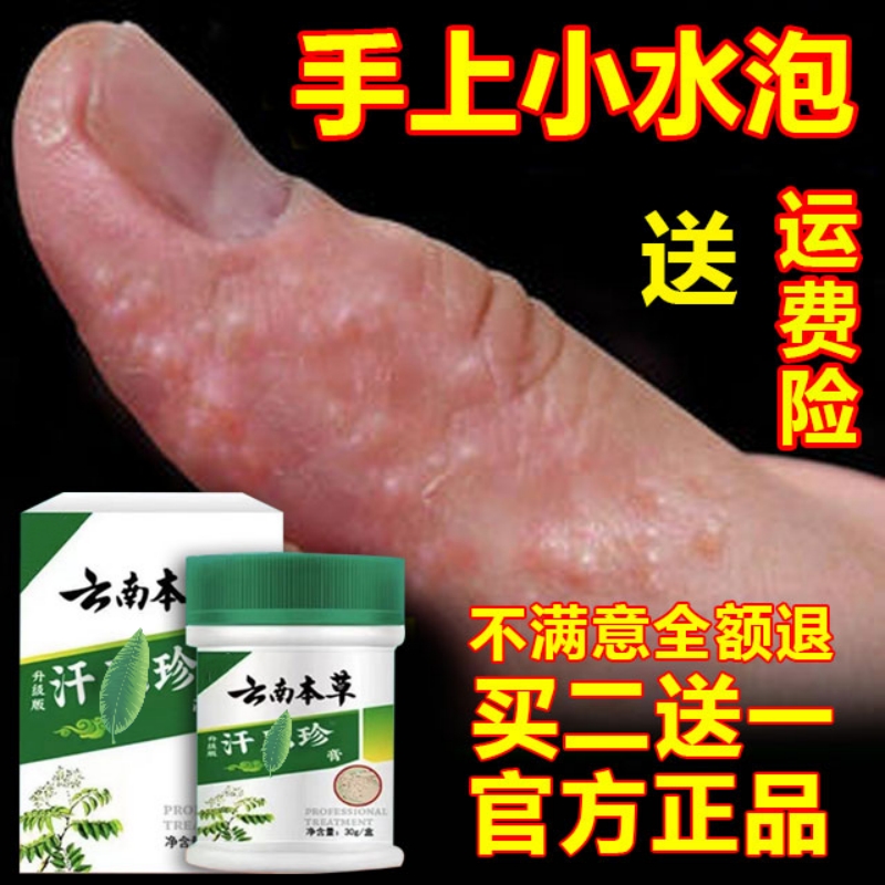 云南本草手上水泡手脚痒抑菌乳膏抓挠手心掌背脚底泡泡止痒汗疱膏