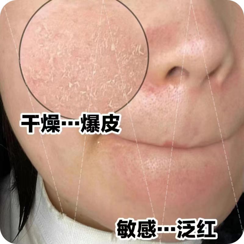 脸上起皮干燥脸干脸部干燥起皮脱皮保湿护肤脸起干皮掉皮保湿甘油