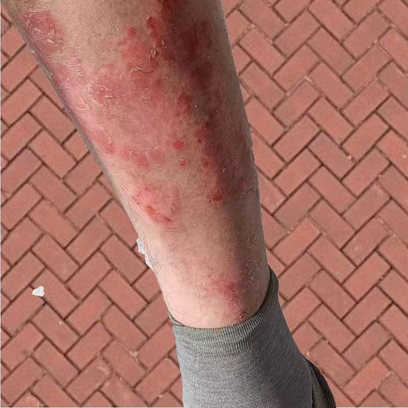 腿上小腿皮肤痒湿毒痒皮肤痒抓出血湿毒疙瘩身上痒止痒抑菌软膏