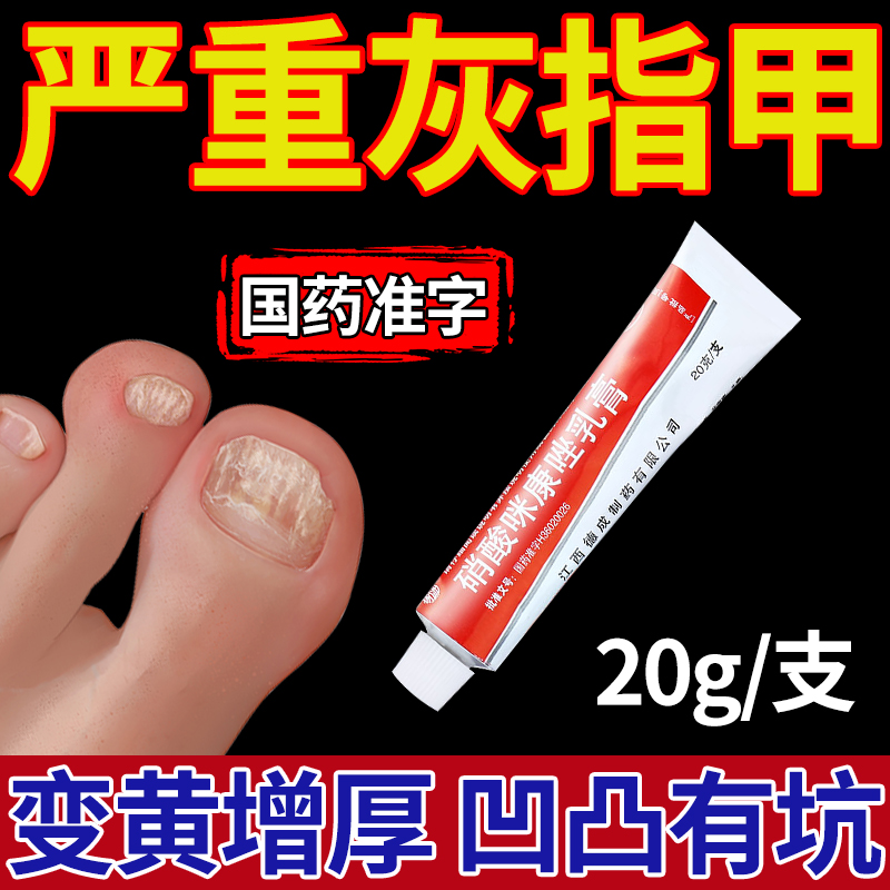 扬子洲治灰指甲真菌感染指甲发黄变厚空甲 硝酸咪康唑乳膏2%*20g
