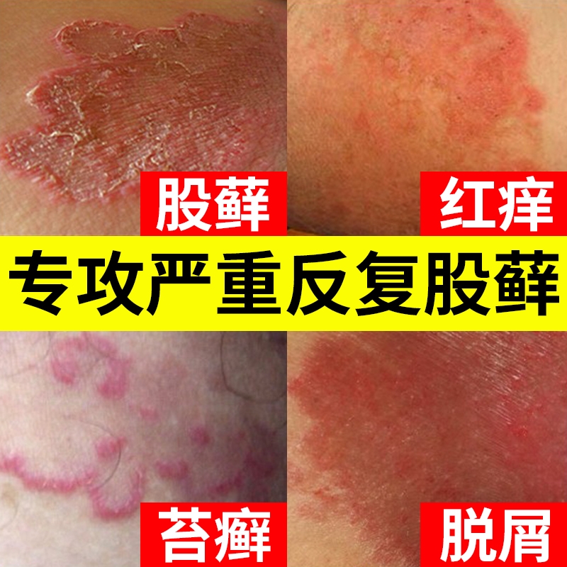 大腿内侧股藓癣皮肤瘙痒百草止痒湿疹外用顽固皮炎特效止痒膏