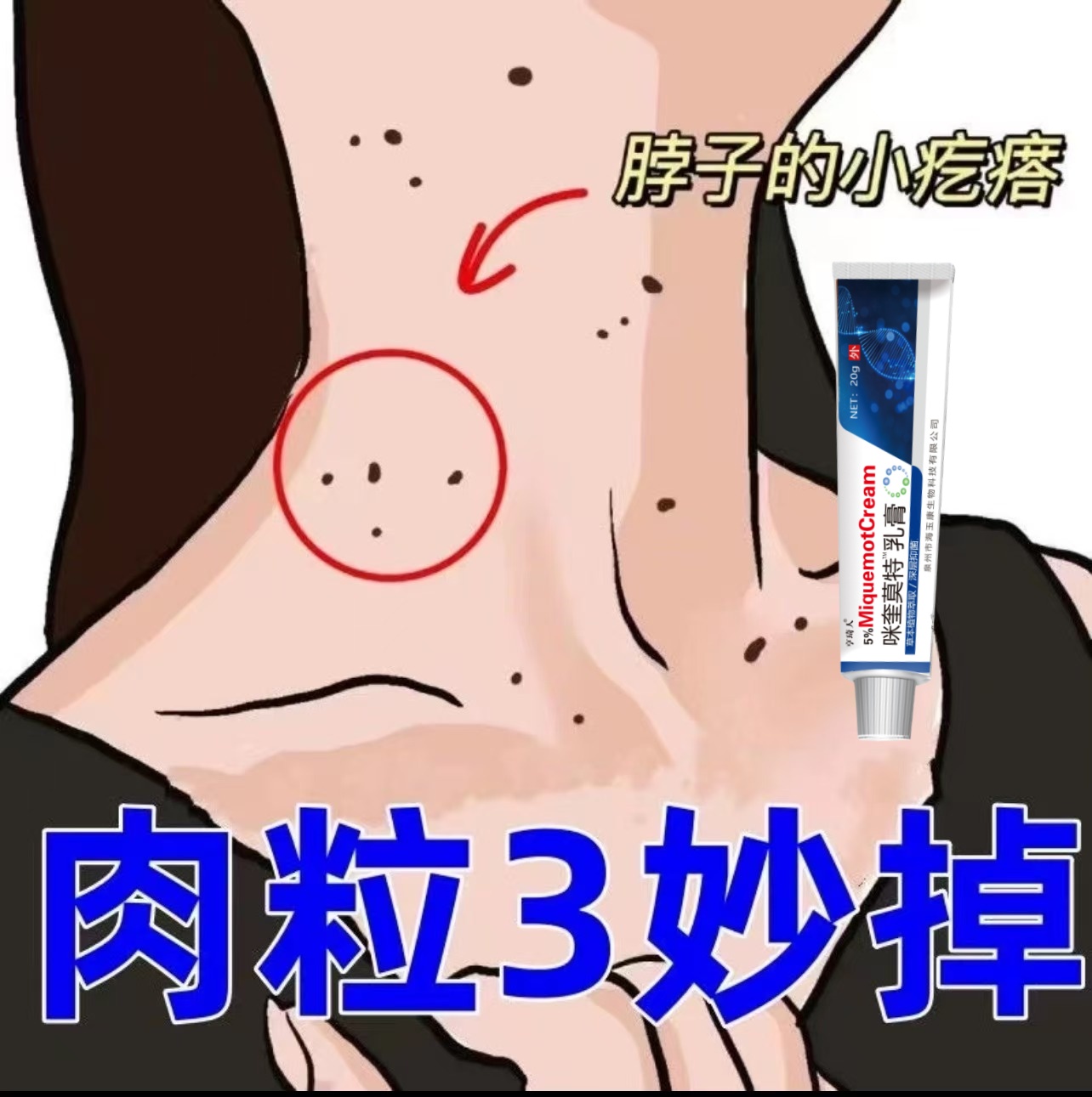 【官方直售】咪奎莫特乳膏5%扁平丝状寻常腋下脖子肉粒20g/支软膏