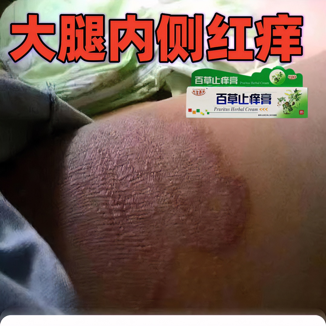 草本膏清洁大腿内侧痒发黑大腿根起干皮烧裆止痒抑菌软膏