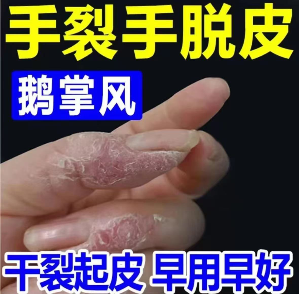 手指干裂脱皮手痒手裂手足起泡裂口开口开裂发痒掉皮手足蜕皮膏