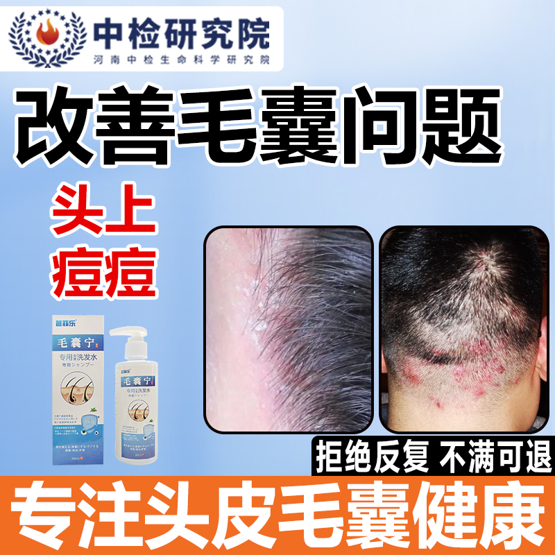 毛炎宁毛囊专用洗发水煤焦油洗剂头皮头部长红疙瘩痘痘去屑止痒