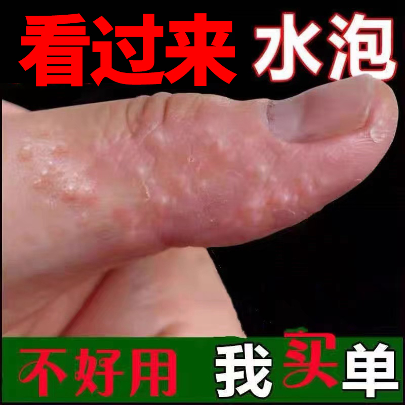 手上起小水泡手痒水泡脱皮干裂痒膏起皮干燥季节性抗反复止痒软膏