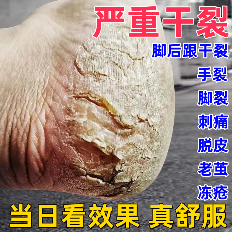 足跟皴裂凝露脚后跟干裂起皮保湿皴裂霜护手脚开裂皲裂足裂修复霜