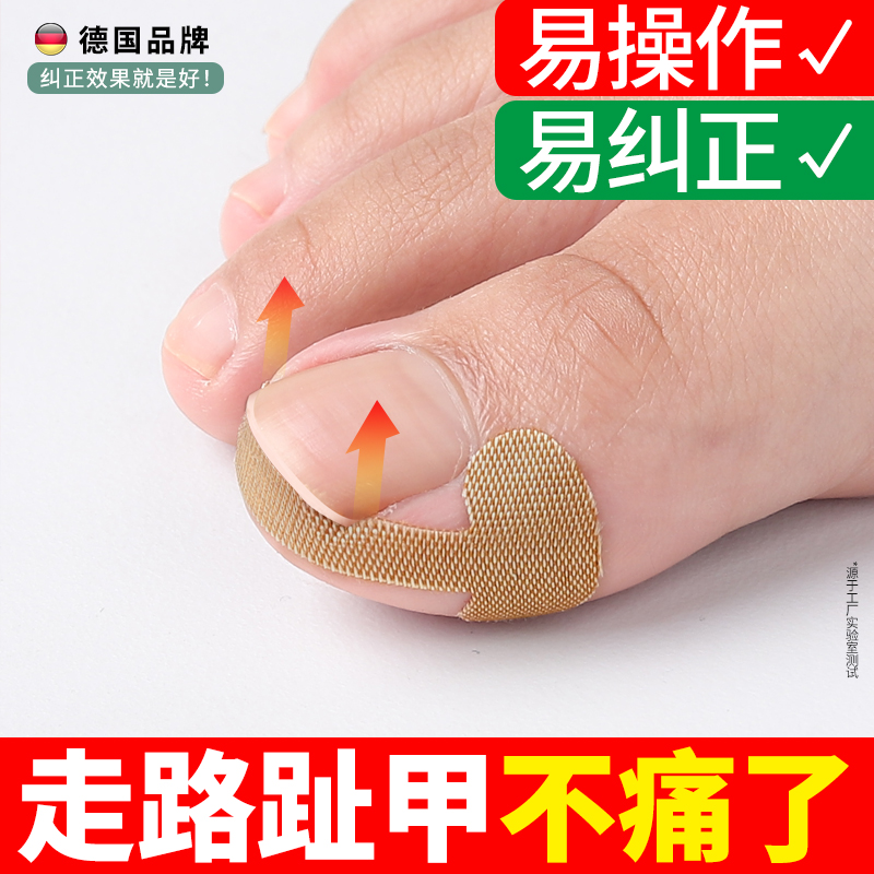 【小扬哥甄选】甲沟矫正器嵌甲往肉里长专用隔离贴片纠正脚趾甲指