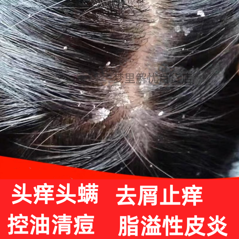 洗发水治脂溢性皮炎去严重头皮屑止痒神器煤焦油洗剂修研抑菌洗液